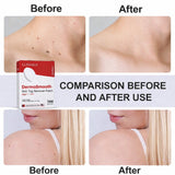 LUHAKA™ DermaSmooth Skin Tag Remover Patches (BUY 1 GET 1 FREE )