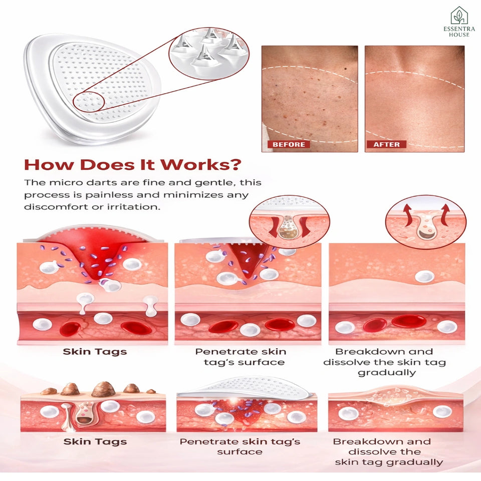 LUHAKA™ DermaSmooth Skin Tag Remover Patches (BUY 1 GET 1 FREE )